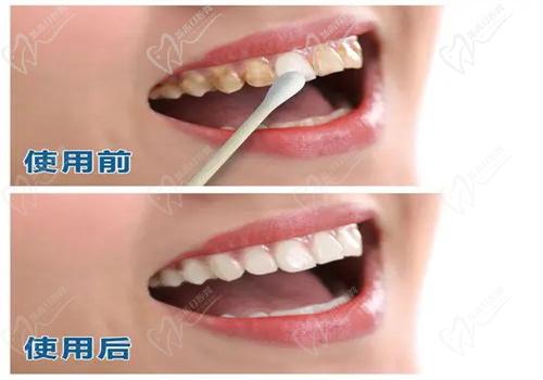 牙齒美白有哪些方法？