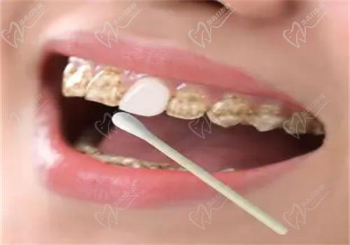 牙齒美白有哪些方法？